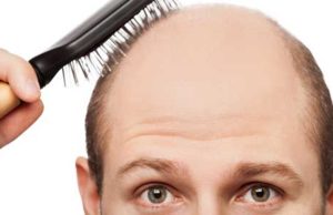 Saç Dökülmesinin 9 nedenine dikkat-Memorial Etiler Tıp Merkezi Dermatoloji Bölümü'nden Uz. Dr. Zerrin Baysal